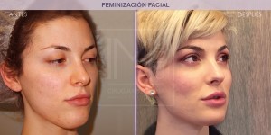 Before and after pictures of Facial Feminisation Surgery